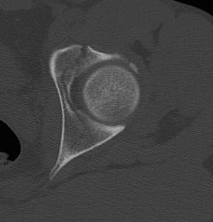 Acetabular Fracture Transverse CT1